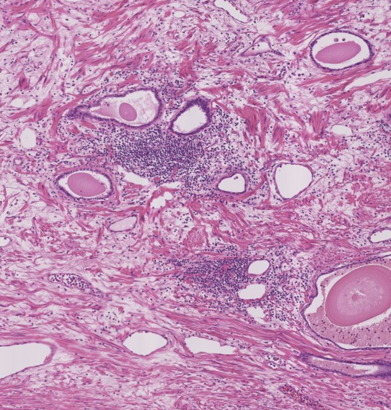 Histopathologisches Bild: Prostatahyperplasie mit knotiger Architektur